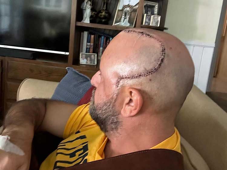 عکس جراحی مغز